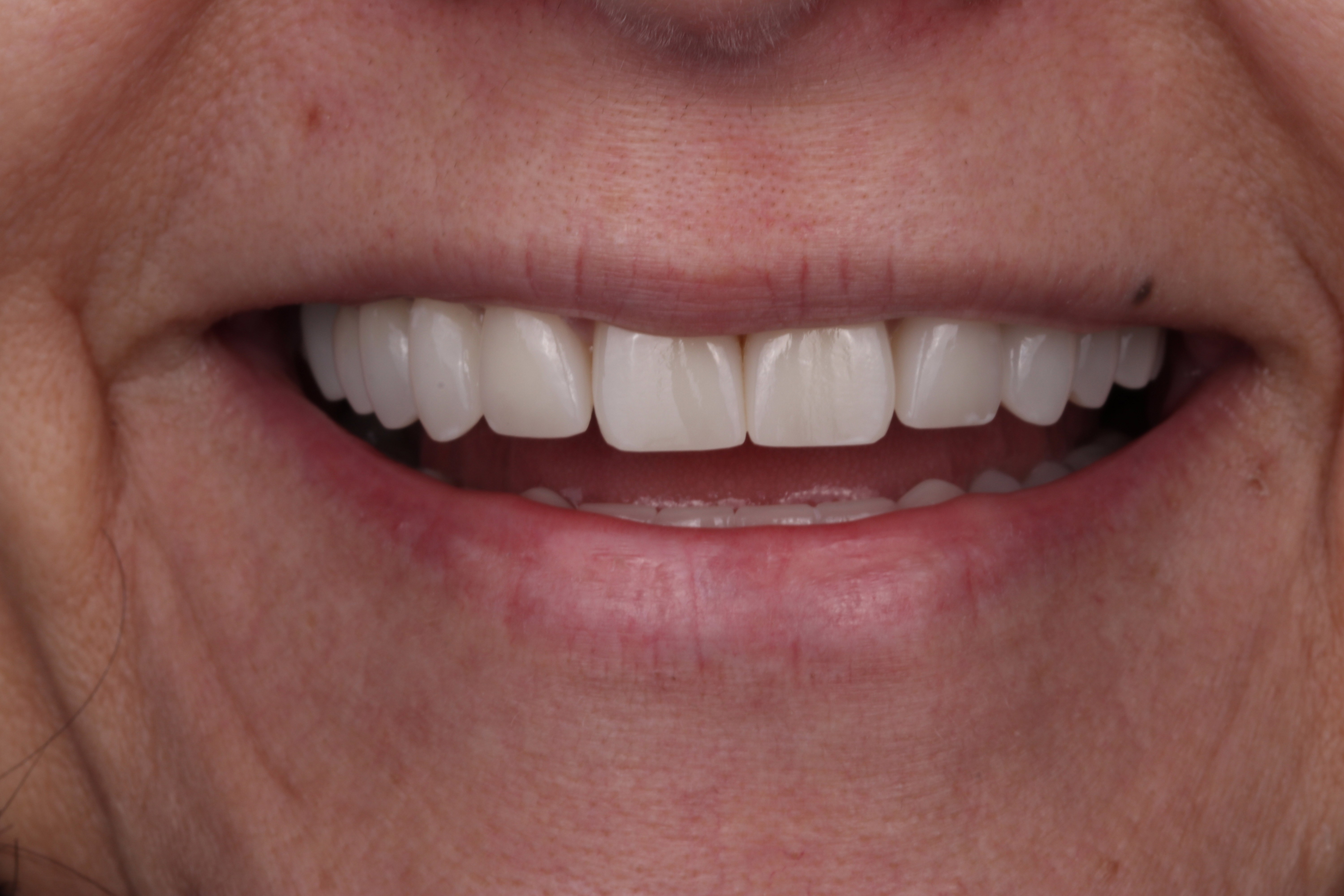 After full mouth rehabilitation with crown and bridge using the Broughton Bite Lift System