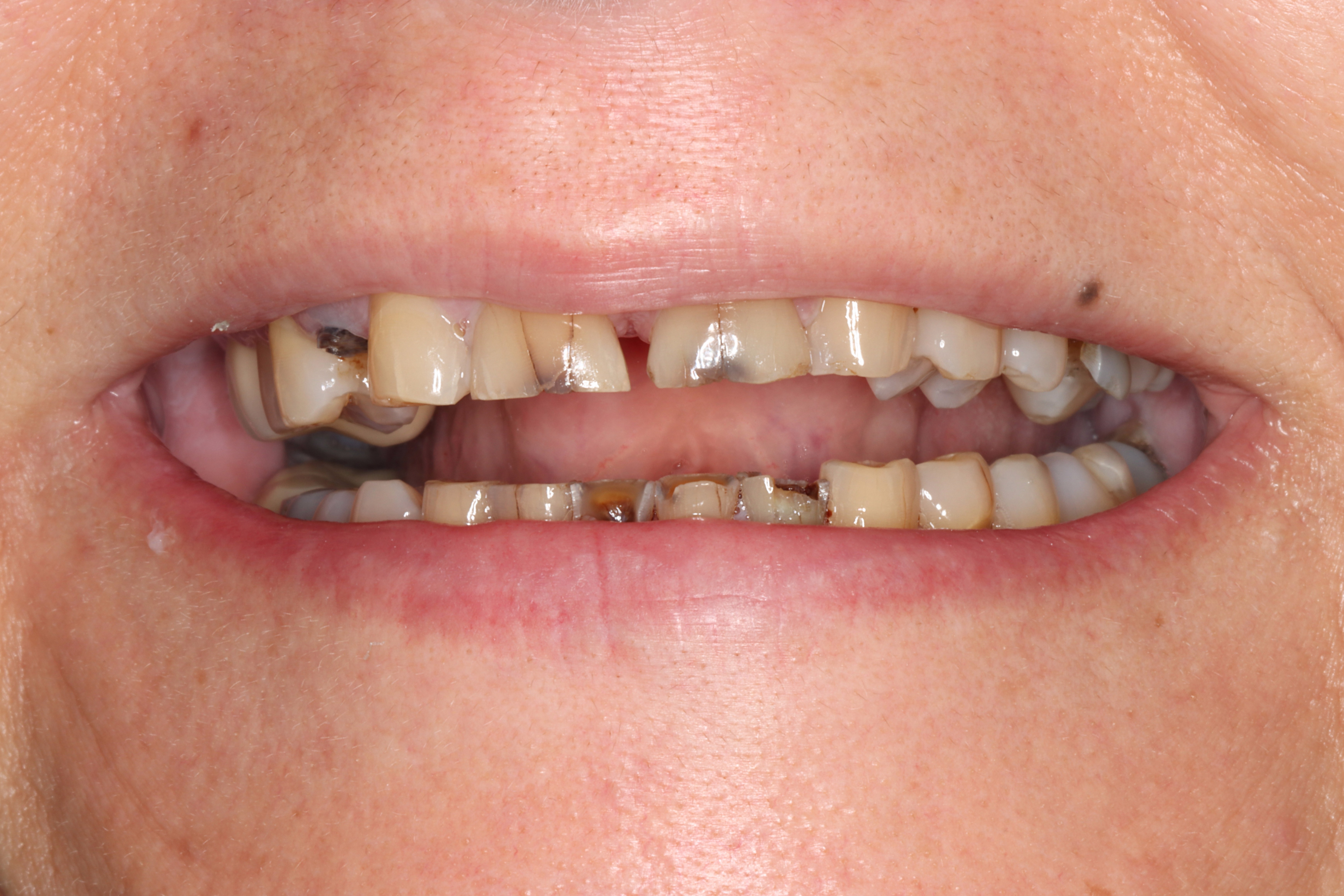 Before severe decay, missing teeth, and collapsed bite