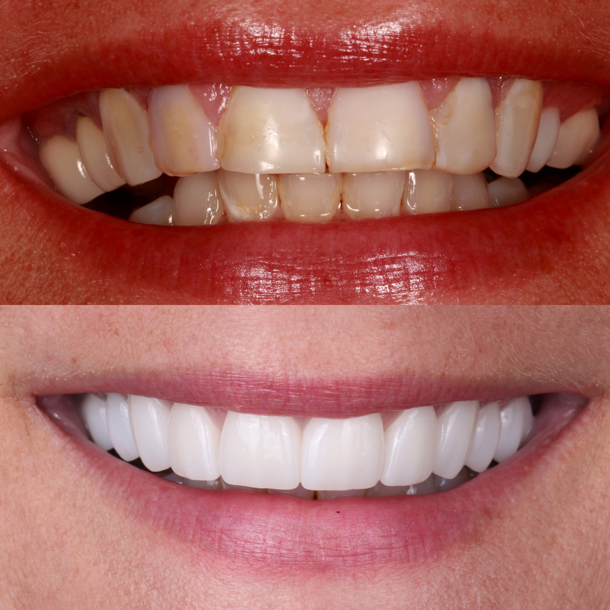 Before and after full arch rehabilitation using the Broughton Bite Lift System