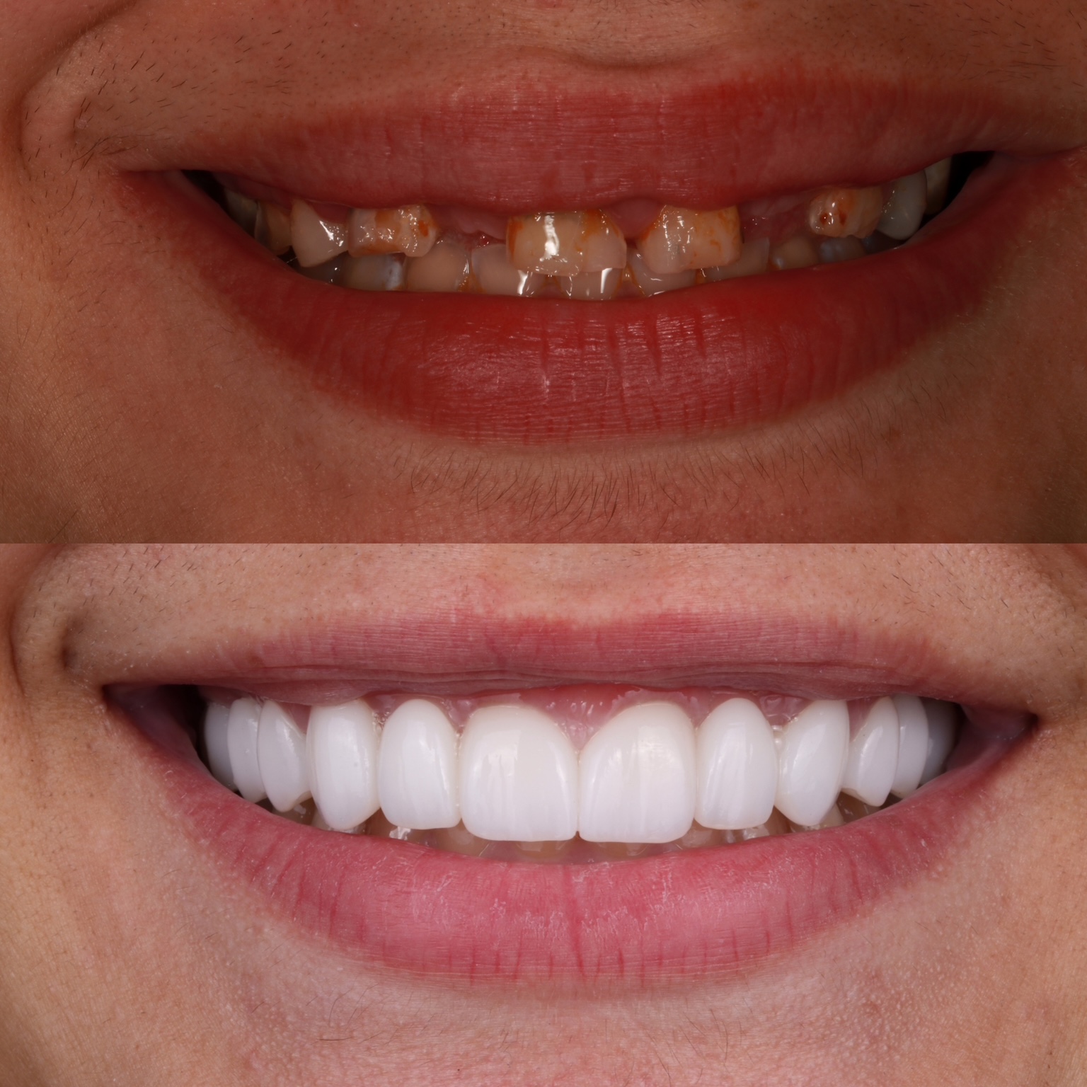 Before and after gum lift with porcelain restorations restoring bite and smile