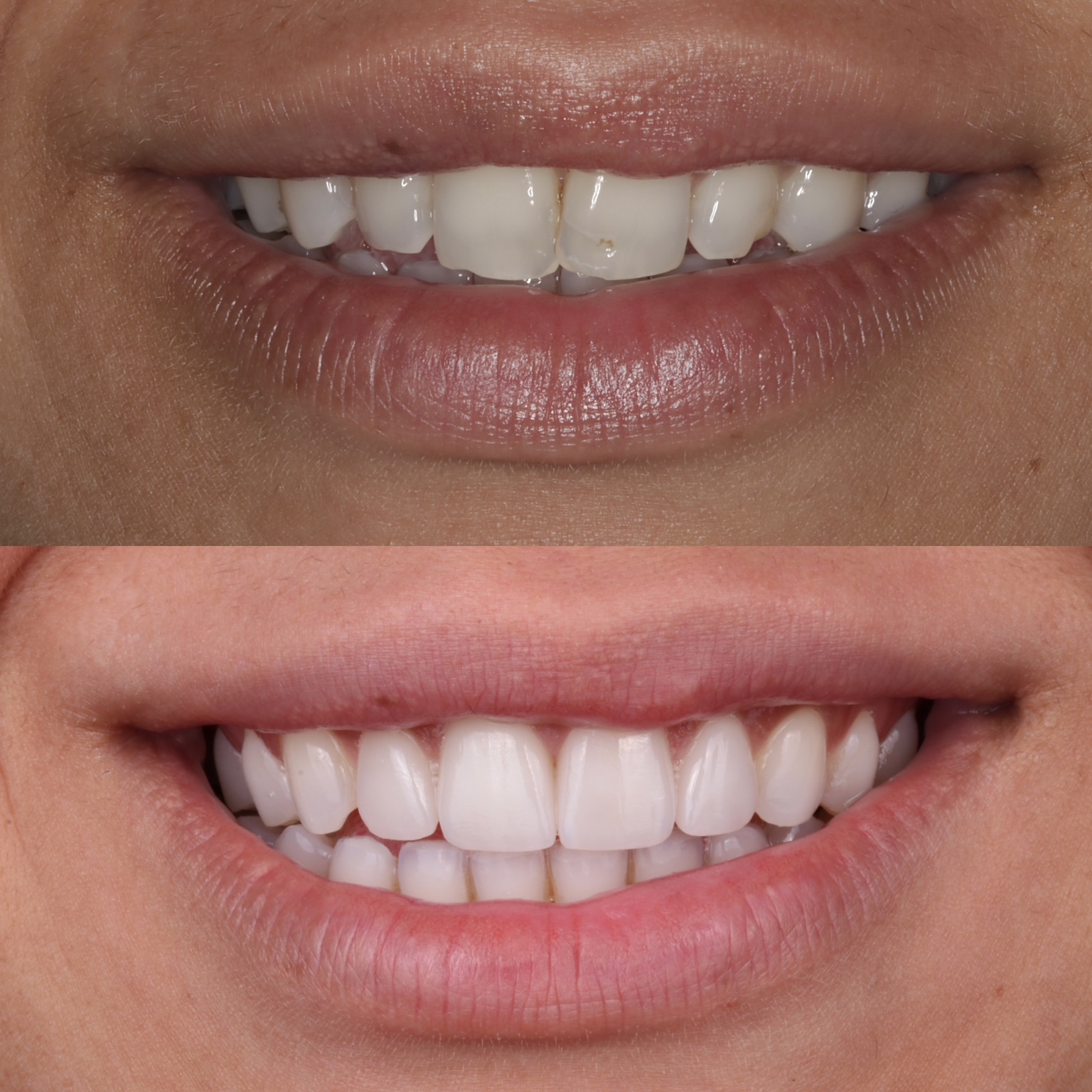 Before and after whitening and four porcelain veneers
