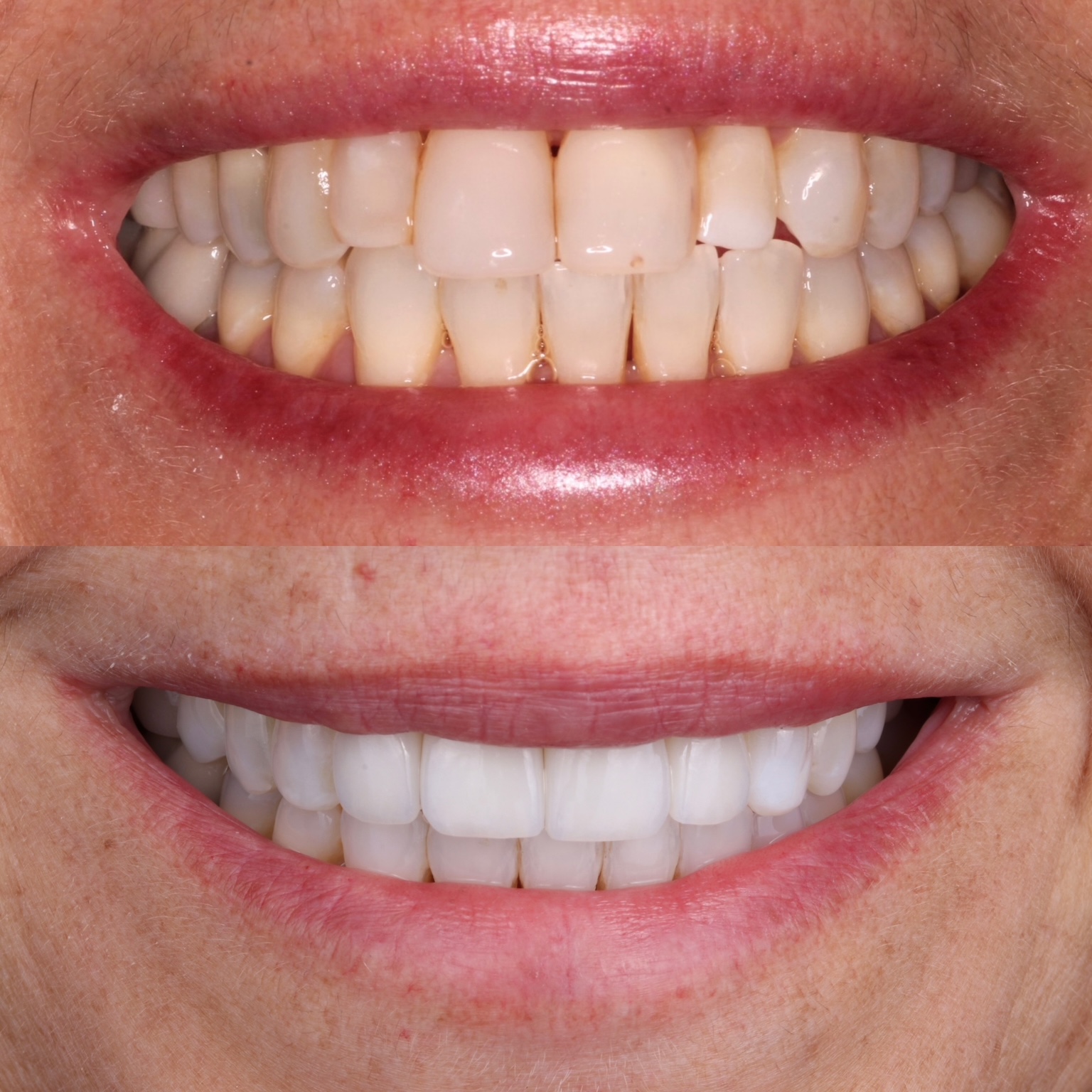 Before and after Invisalign, whitening, and four veneers for a conservative smile correction