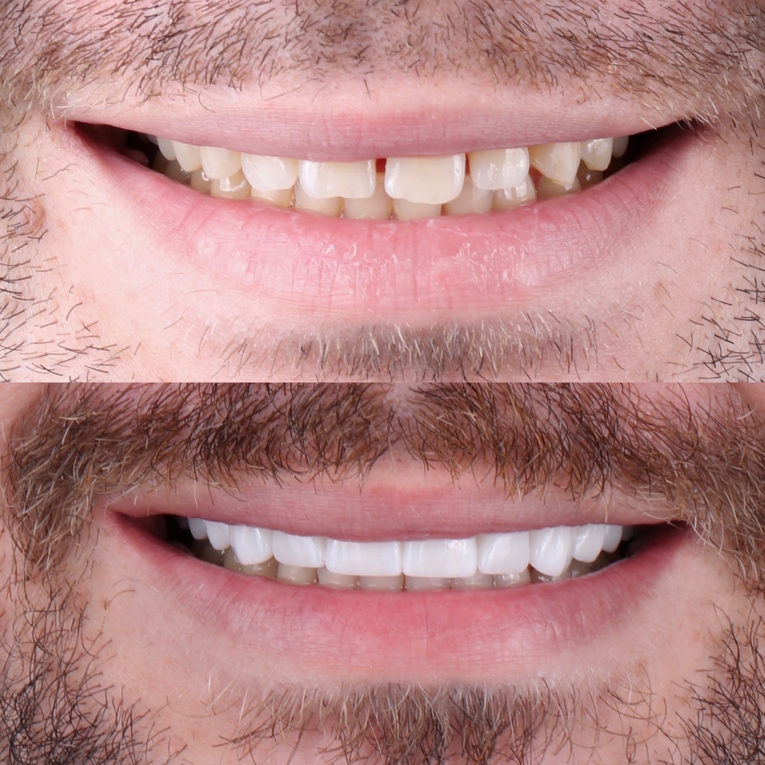 Before and after porcelain restorations correcting position and shade before a wedding