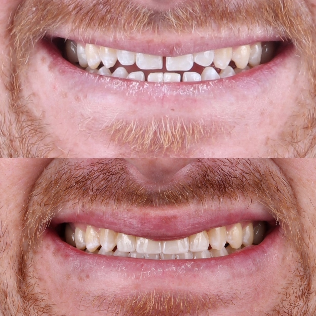 Before and after Invisalign and four porcelain veneers closing front-tooth spaces