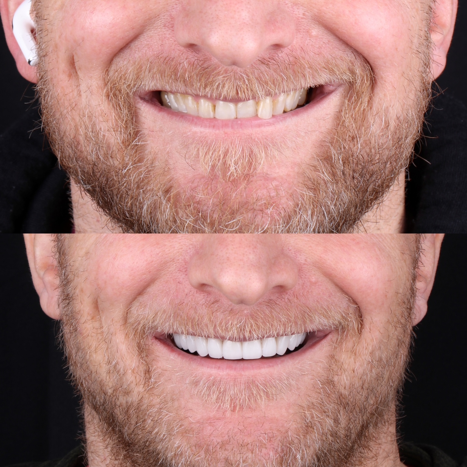 Before and after full-mouth porcelain veneer restoration completing a previous Invisalign case